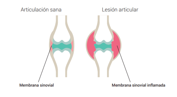 Sobre la artritis – imagen 2